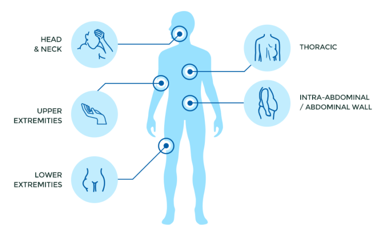 Desmoid Tumor / Fibromatosis (DeFi) Trial - SpringWorks Therapeutics